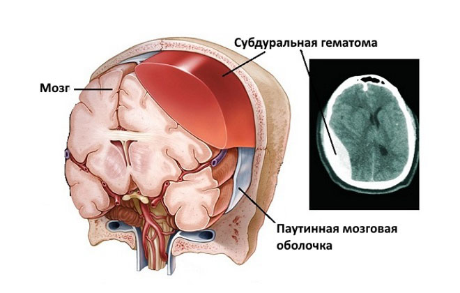 Субдуральная гематома - нейрохирургия киев