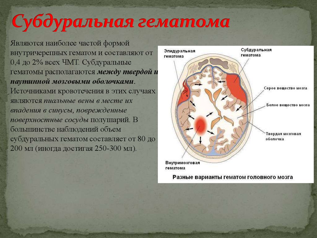 Внутричерепная гематома гематома головы головного мозга кровоизлияние в мозг кровоизлияние в голову лечение украина